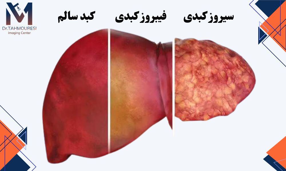 چه عواملی باعث پیشرفت فیبروز به سیروز میشوند؟ چه عواملی باعث پیشرفت فیبروز به سیروز میشوند؟