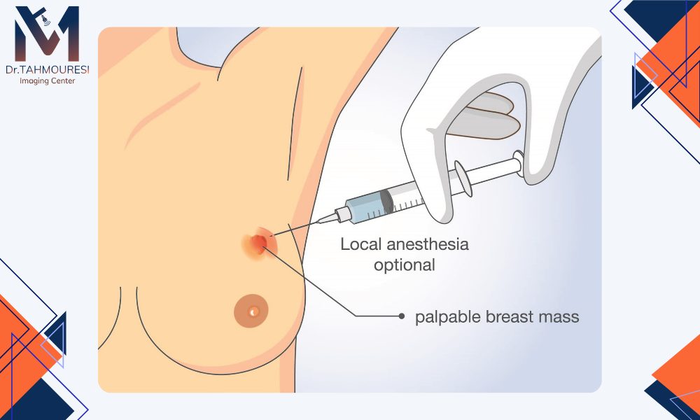 نکات مهم پس از biopsy سینه