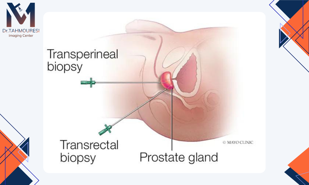 بیوپسی پروستات 