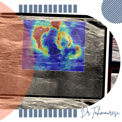 Elastography پستان برای چه کسانی توصیه می‌شود؟ 