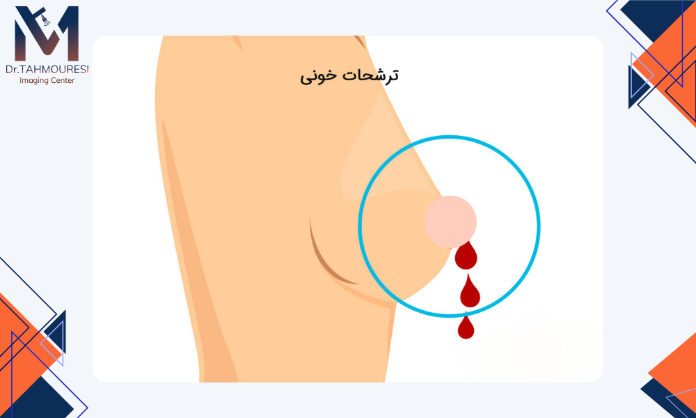 علائم هشداردهنده سرطان پستان