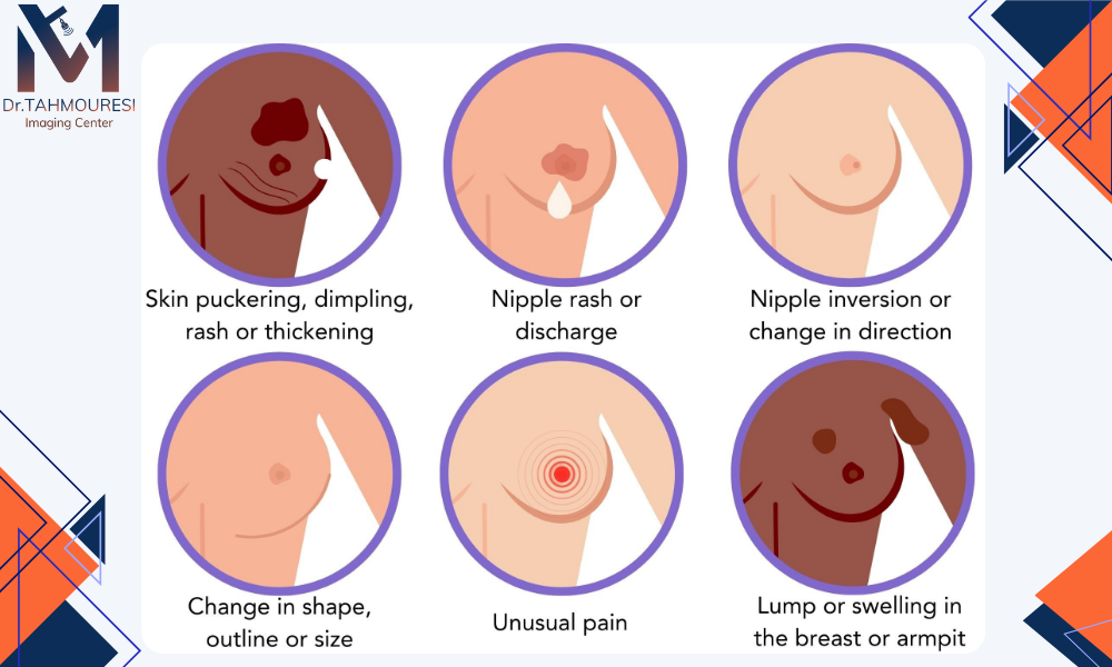 نشانه های سرطان سینه