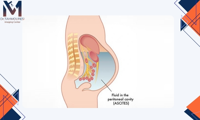 مراقبتهای بعد از درمان تخلیه شکم مراقبتهای بعد از درمان تخلیه شکم