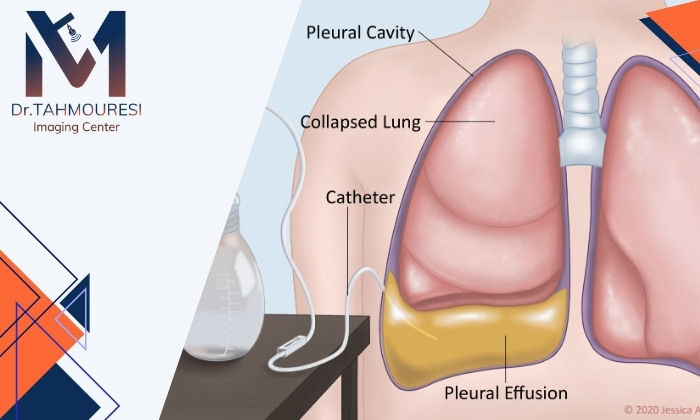 لوله‌گذاری مایع پلور در درمان چه مشکلات ریوی مورد استفاده قرار می‌گیرد؟