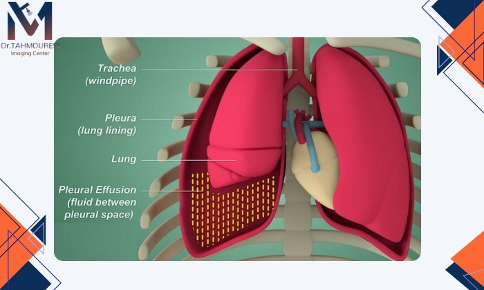 آب آوردن ریه با نارسایی قلب
