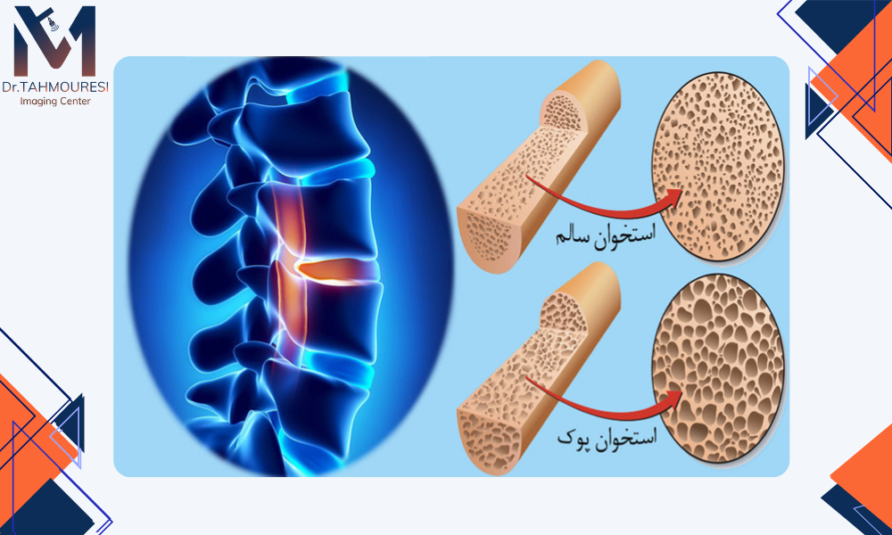 اهمیت BMD