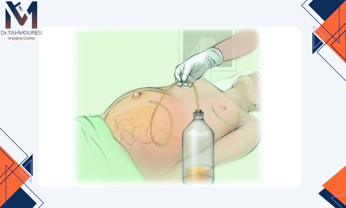 آیا تخلیه آب شکم خطر دارد؟ آیا تخلیه آب شکم خطر دارد؟