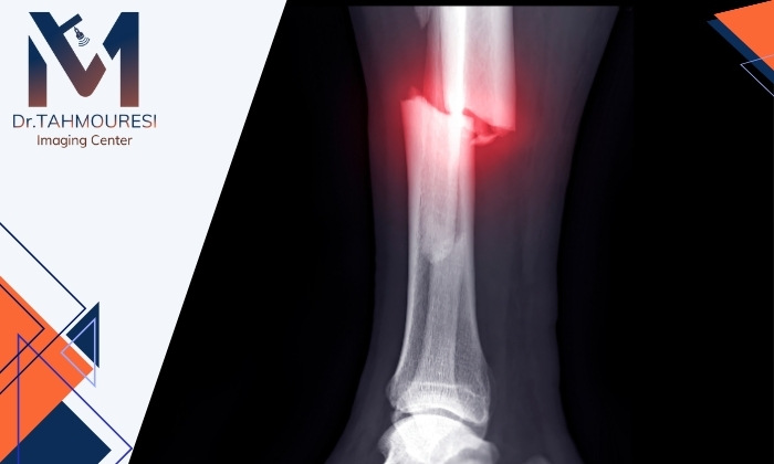 آیا شکستگی استخوان فقط با عکس ساده معلوم می‌شود؟