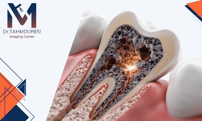 آیا عفونت ریشه دندان در رادیولوژی قابل تشخیص است؟