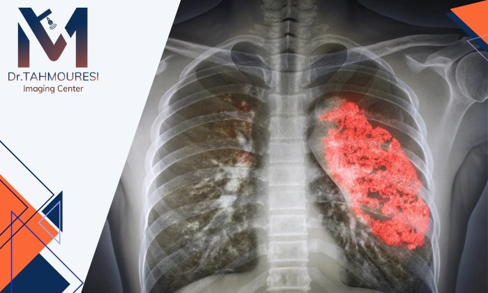 آیا عکس ریه می‌تواند پنومونی را نشان دهد؟ آنچه باید بدانید