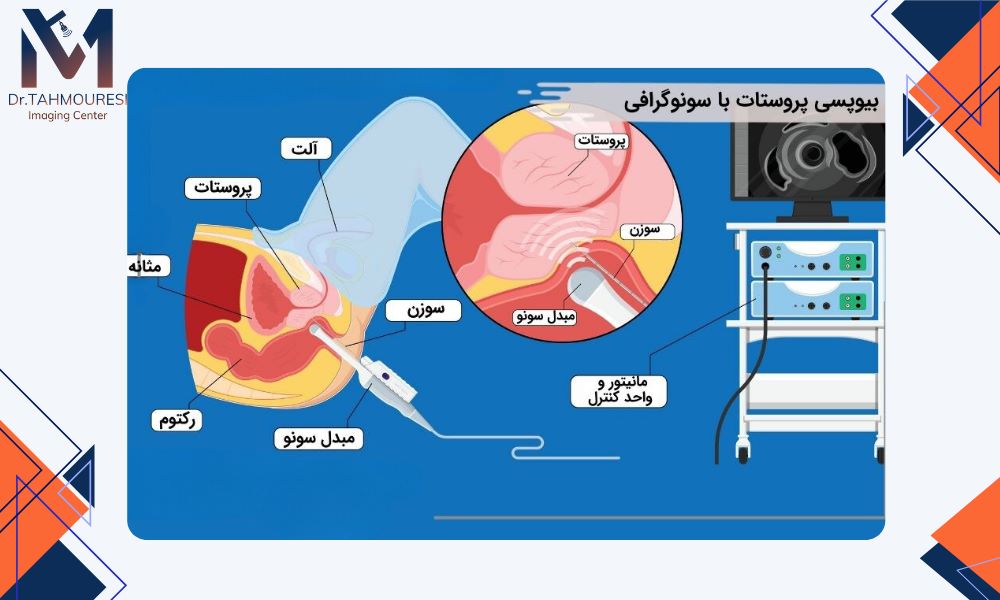 روش‌های تشخیص سرطان پروستات