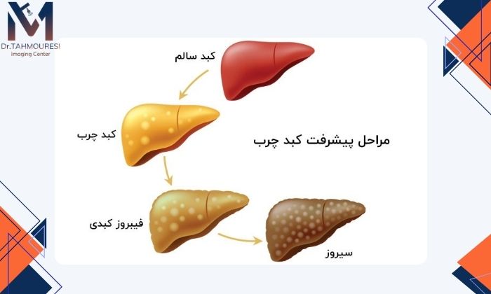 آیا کبد چرب می‌تواند به مشکلات جدی‌ تبدیل شود؟