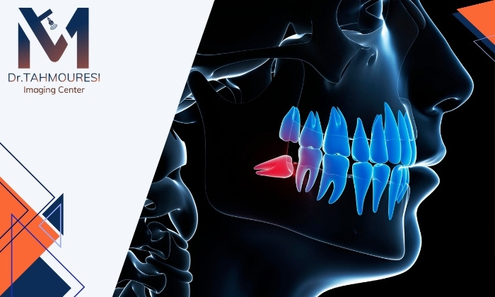 از کجا بفهمم دندان عقلم نیاز به جراحی دارد؟ از کجا بفهمم دندان عقلم نیاز به جراحی دارد؟