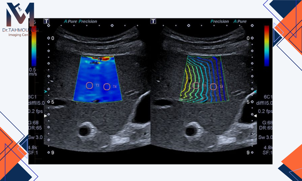 مقایسه الاستوگرافی در کنار سایر روش‌های تصویربرداری کبد 