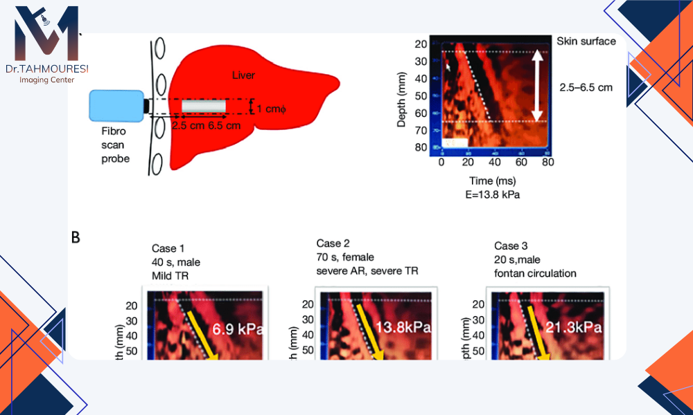 مقایسه الاستوگرافی در کنار سایر روش‌های تصویربرداری کبد 