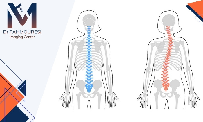 انحراف ستون فقرات چگونه تشخیص داده می شود و چرا مهم است؟