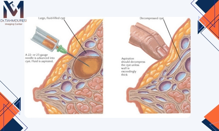 انواع کیست سینه