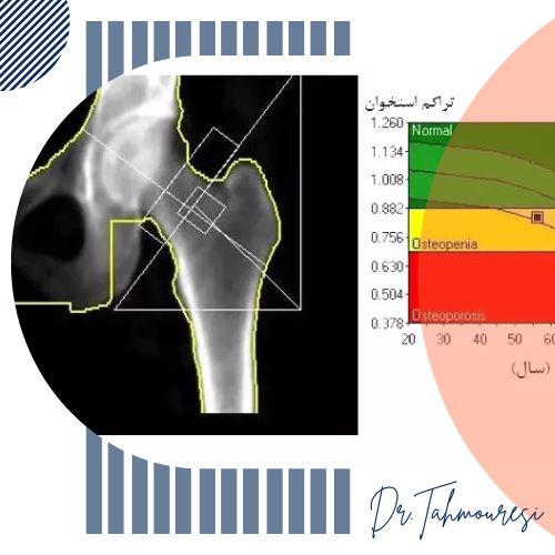 کاربرد سنجش تراکم استخوان کاربرد سنجش تراکم استخوان