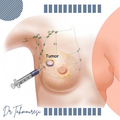 بیوپسی توده پستان چیست؟
