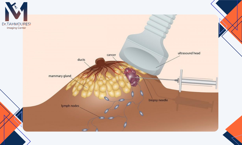 تفاوت بیوپسی برست با هدایت سونوگرافی و سایر روش‌های بیوپسی