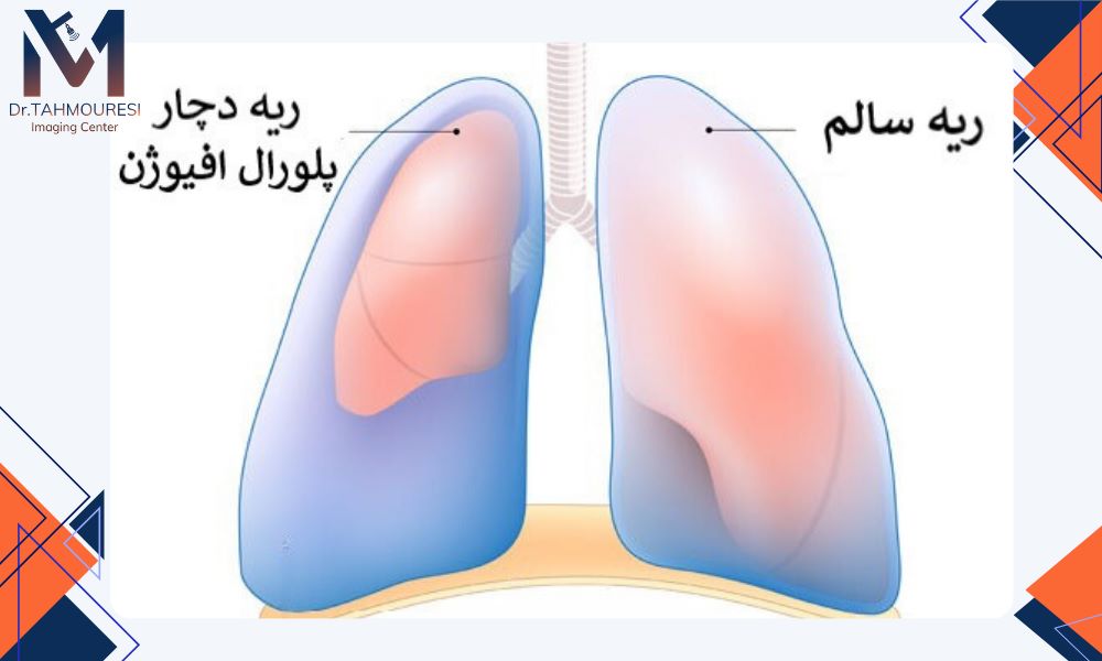 آیا درناژ و تخلیه آب ریه باعث بهبود تنفس بیمار میشود ؟