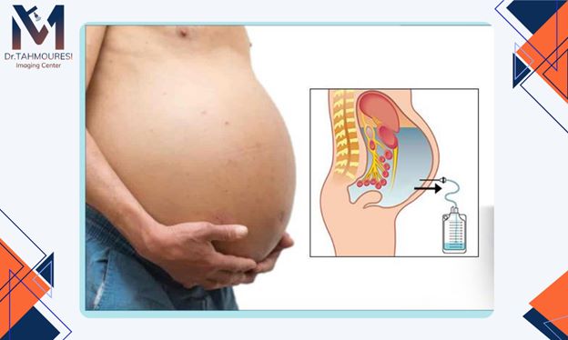 مراقبتهای پس از درناژ تخلیه مایع آسیت مراقبتهای پس از درناژ تخلیه مایع آسیت