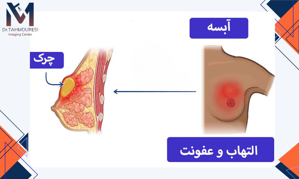 مراقبتهای پس از تخلیه آبسه مراقبتهای پس از تخلیه آبسه