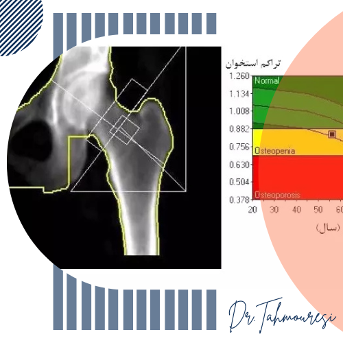 کاربرد سنجش تراکم استخوان