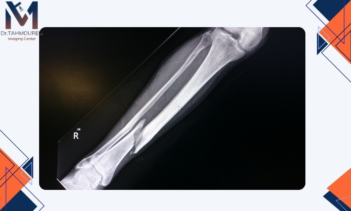 تشخیص شکستگی استخوان با عکس ساده