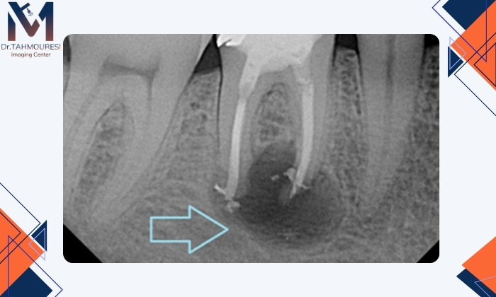 تشخیص عفونت ریشه دندان با رادیولوژی