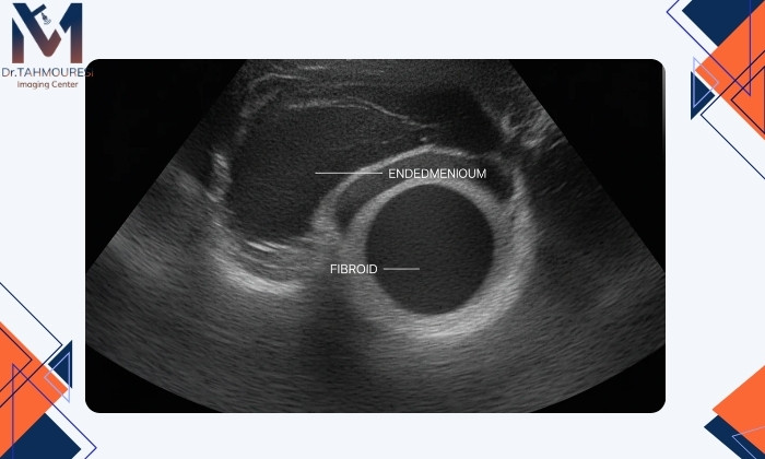 تشخیص فیبروم رحم با سونوگرافی تشخیص فیبروم رحم با سونوگرافی