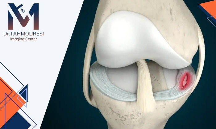 آیا عکس رادیولوژی برای تشخیص پارگی منیسک کافی است؟