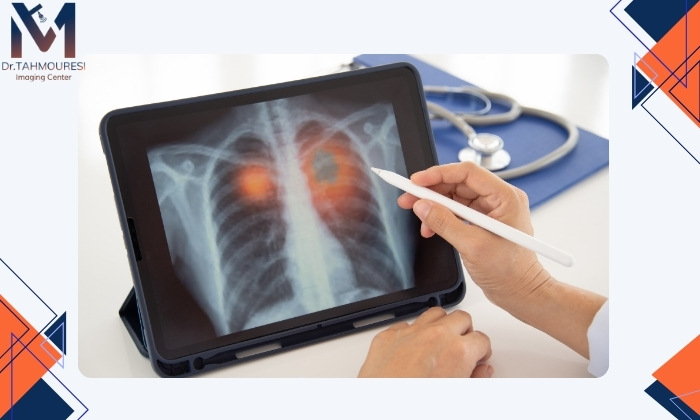 تشخیص پنومونی با عکس ریه