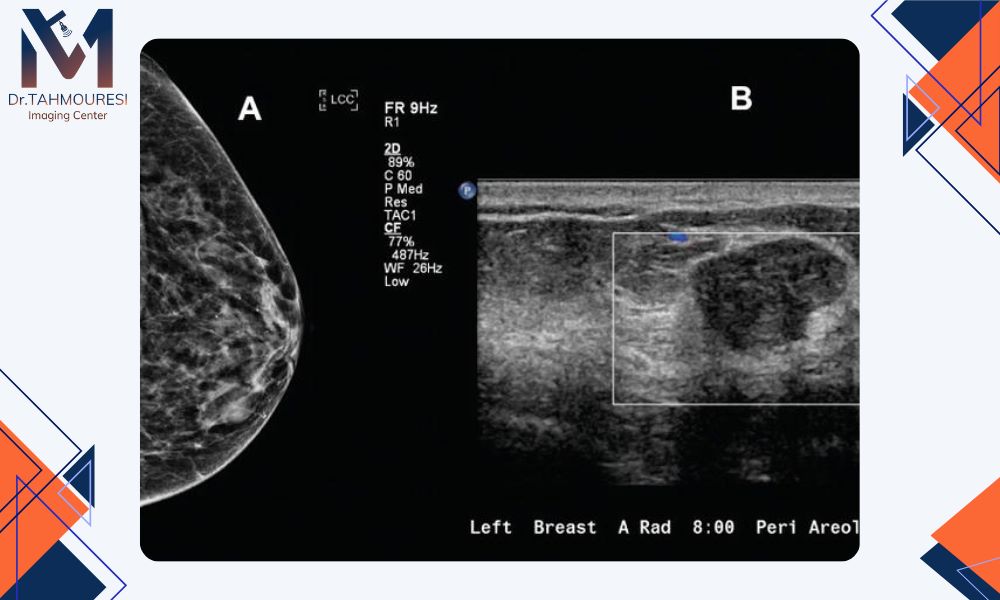 مزایا و معایب Mammography و Ultrasound مزایا و معایب Mammography و Ultrasound