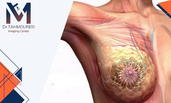 تفاوت کیست و سرطان سینه؛ مقایسه علائم، دلایل و روش‌های درمان