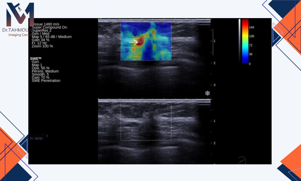 مقایسه elastography  و ultrasound پستان: چه تفاوت‌هایی وجود دارد؟