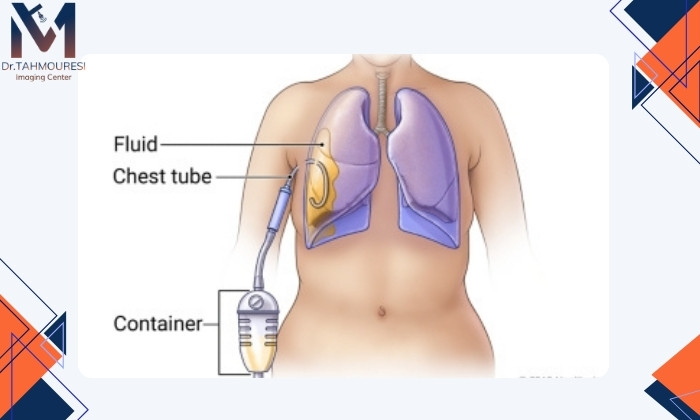 درمان مشکلات ریوی با لوله‌گذاری مایع پلور