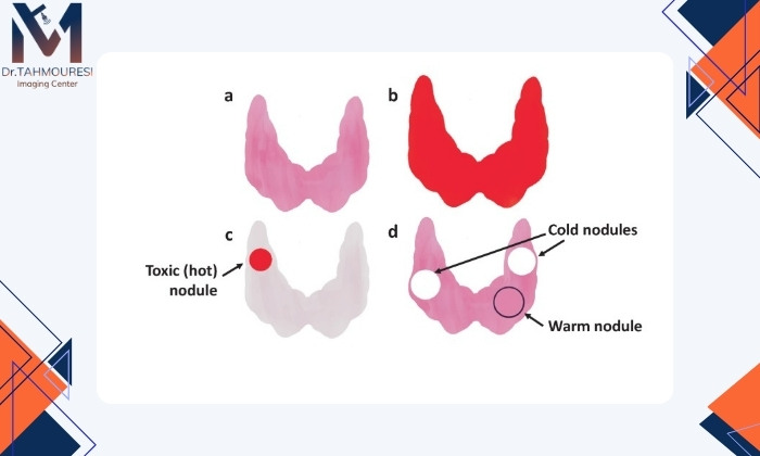 درمان ندولهای غده تیروئید درمان ندولهای غده تیروئید