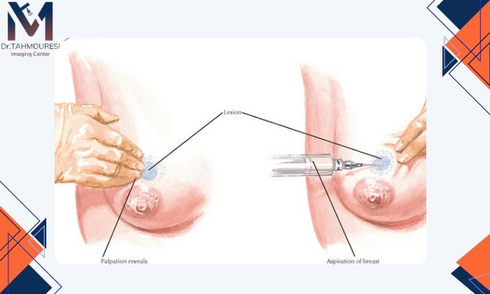 روش‌های تخلیه توده سینه