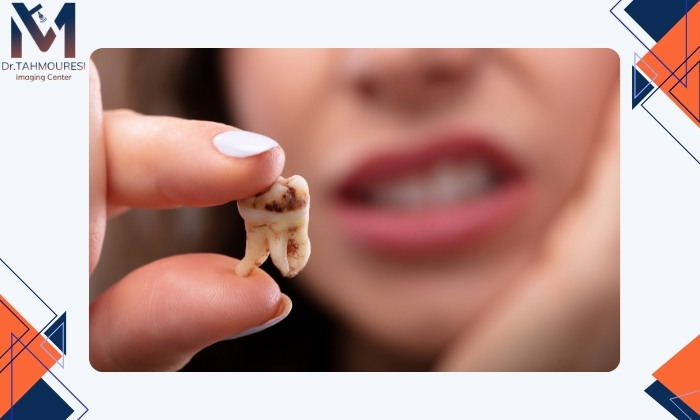 زمان جراحی دندان عقل زمان جراحی دندان عقل