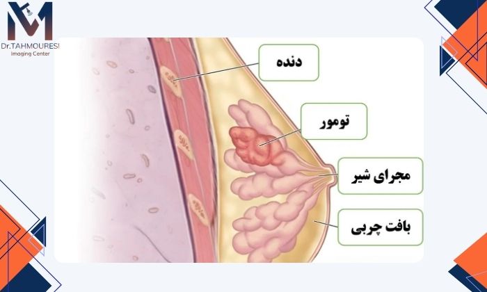 سرطان پستان چیست؟