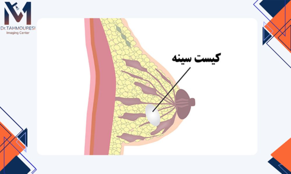 عوامل مؤثر بر علائم کیست برست عوامل مؤثر بر علائم کیست برست