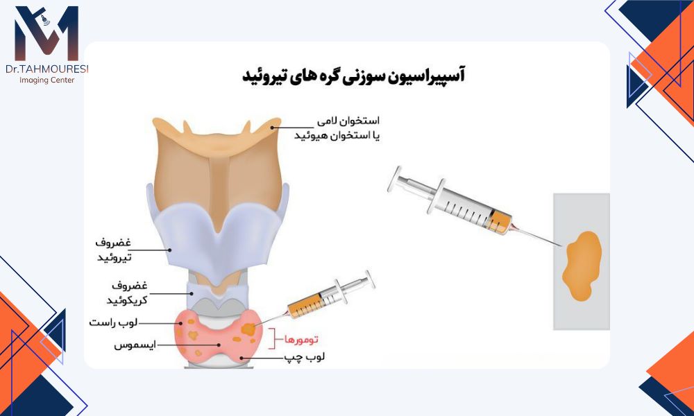 عوارض نمونه برداری تیروئید عوارض نمونه برداری تیروئید