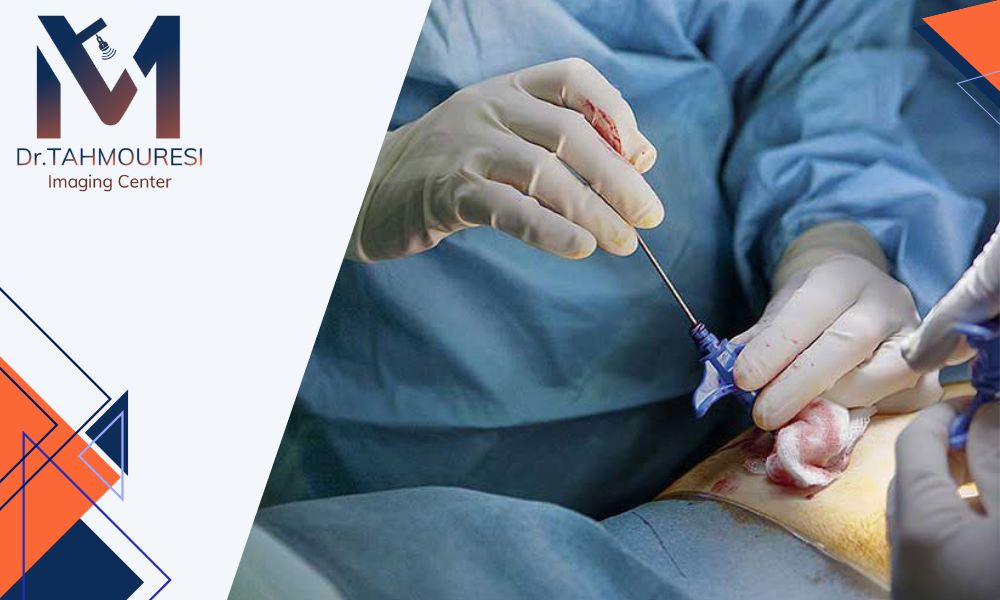 عوارض تخلیه آبسه چیست و آیا باید نگران بود؟
