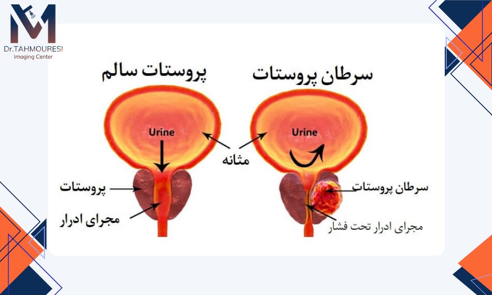 سونوگرافی و بیوپسی در تشخیص سرطان Prostate