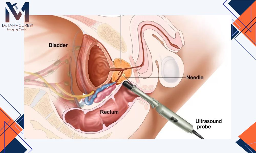 سونوگرافی و بیوپسی در تشخیص سرطان Prostate