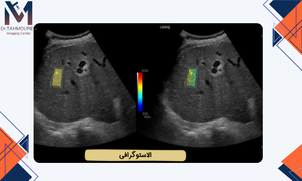 مراحل انجام فیبرواسکن کبد