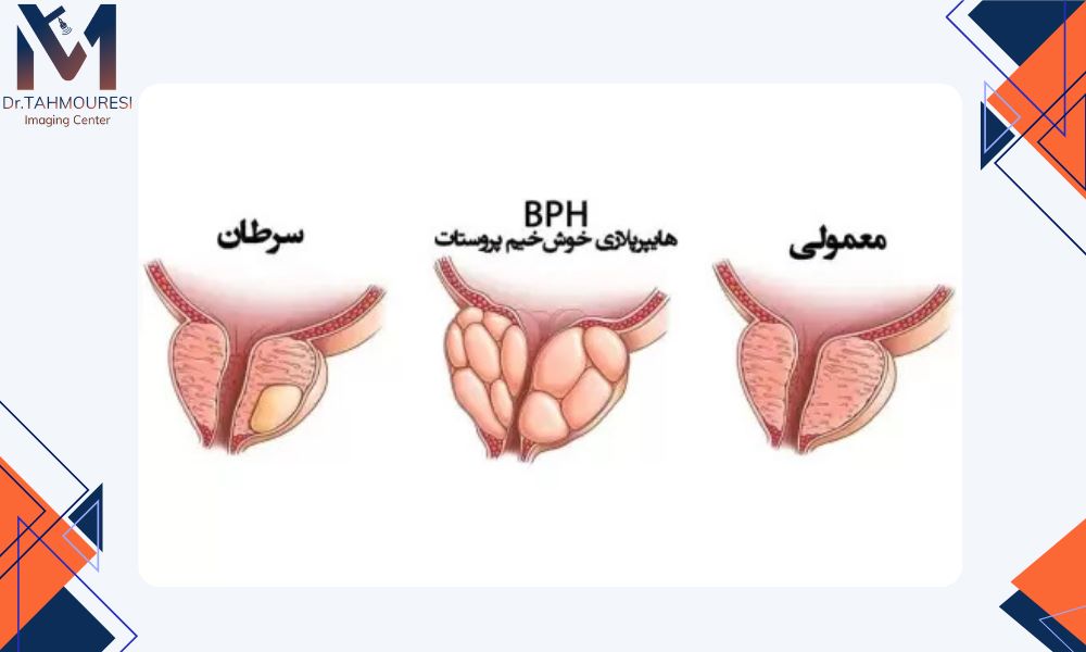 نتایج غربالگری سرطان پروستات: چه باید بدانیم؟ 