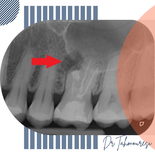 نشانه‌های عفونت در عکس و علائم بالینی