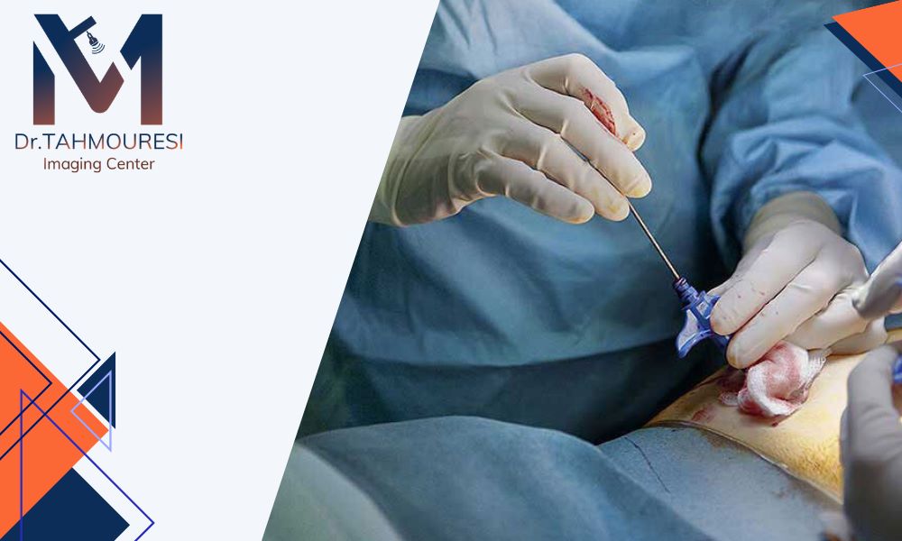 نمونه برداری پروستات در فردیس کرج توسط پزشک متخصص